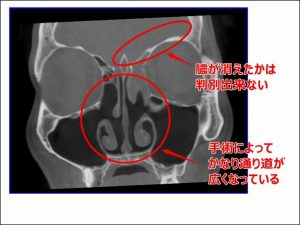 前頭洞炎で手術が必要と診断された僕の、副鼻腔（前頭洞）がどのような状況なのかを解説！ | Love Wife Life